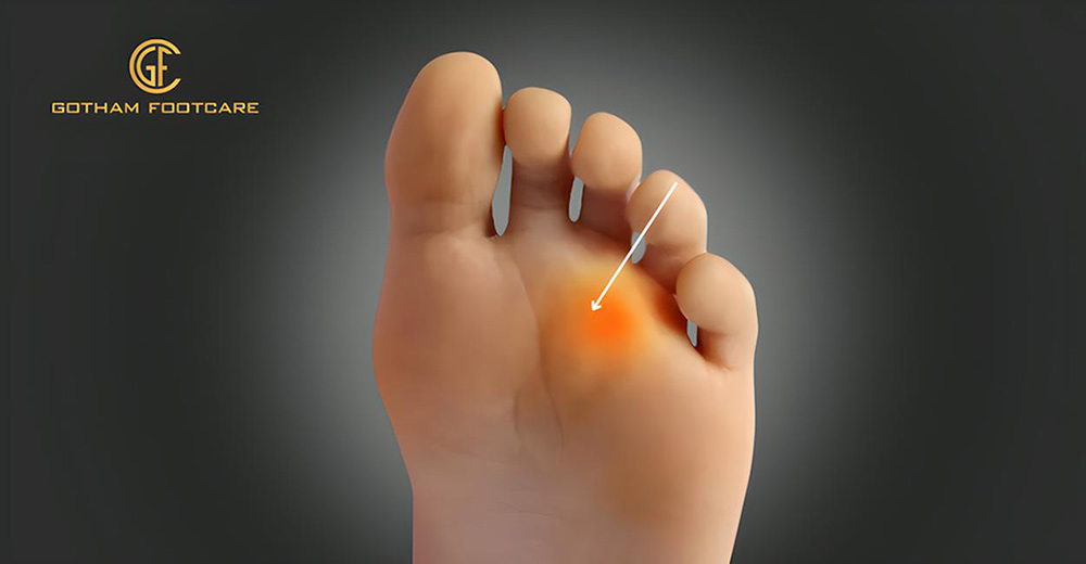Can Morton’s Neuroma Cause Leg Pain?