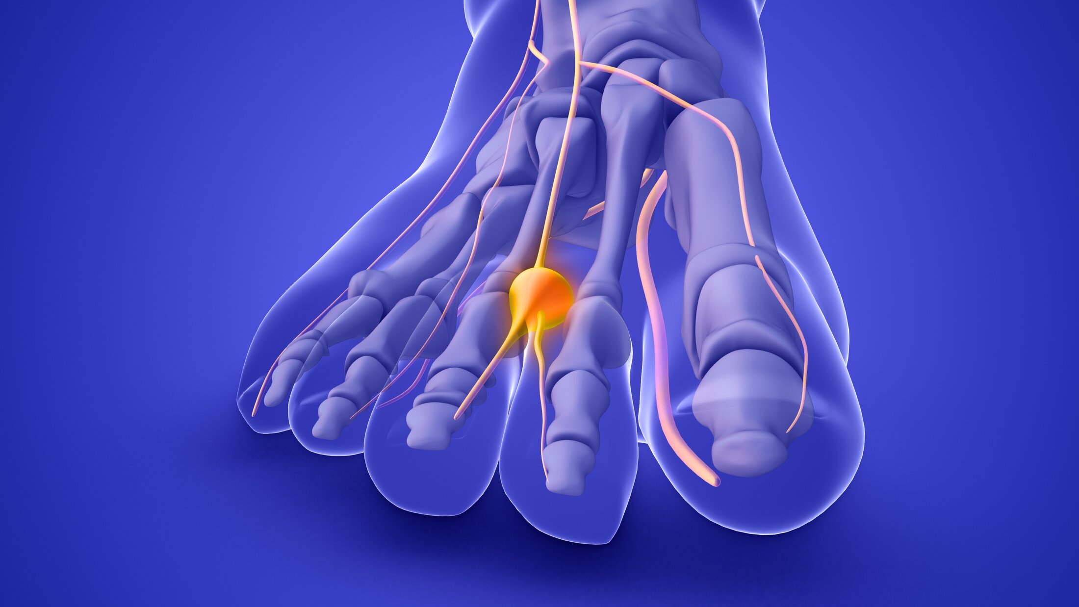 Morton’s Neuroma Treatment- Deciding to Remove or Repair the Nerve with Cryosurgery