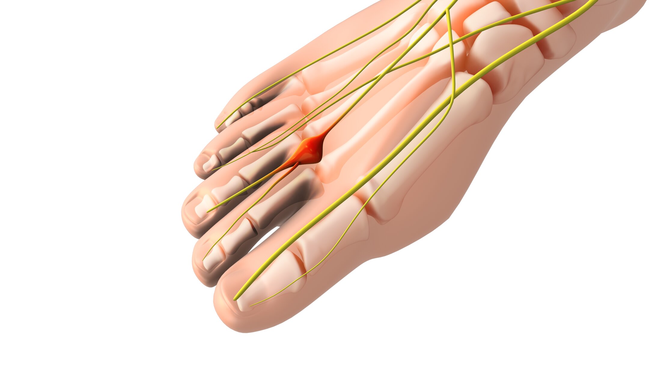 Why Cryosurgery is a Great Choice for Morton&#8217;s Neuroma